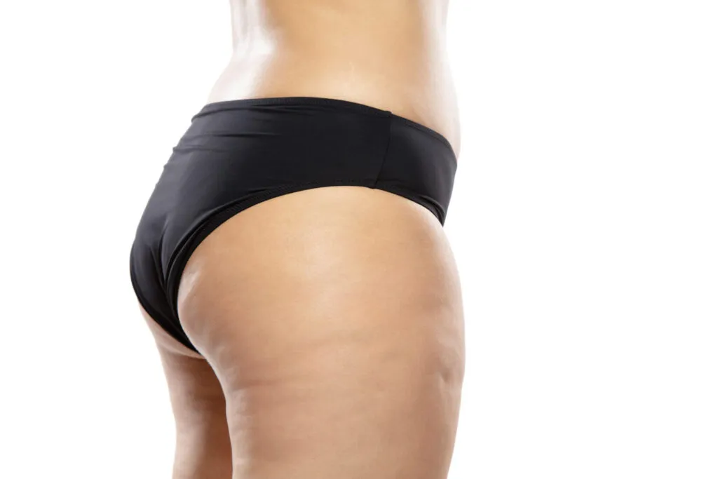 combattere la cellulite