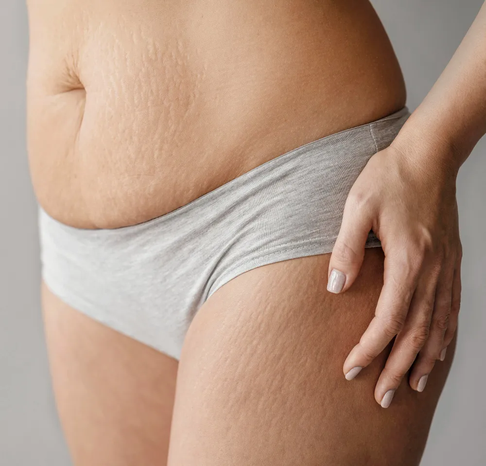 eliminate stretch marks