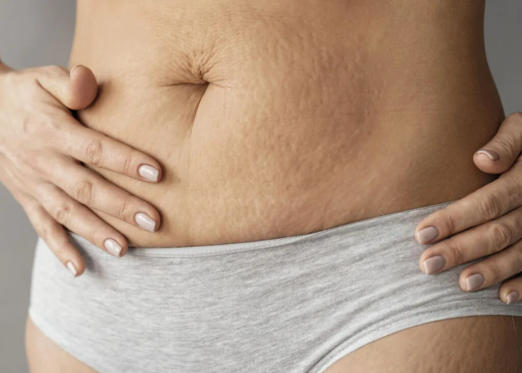 how-eliminate stretch marks